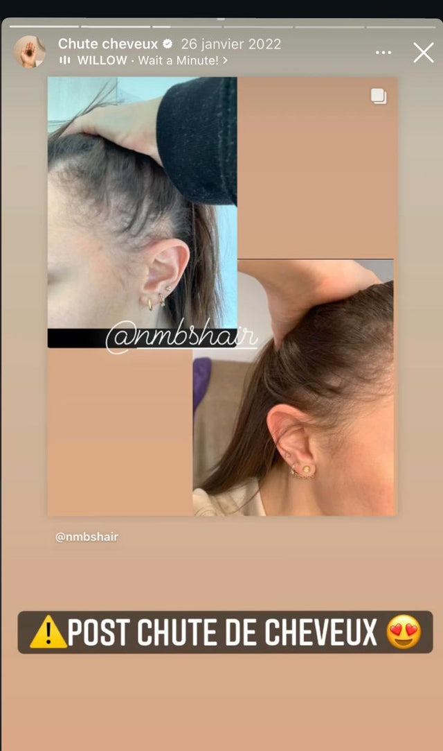 Story @nmbshair · chute de cheveux, comblement