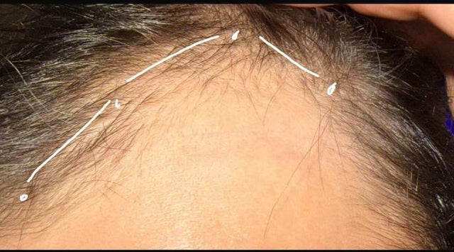 Photo cliente · ligne frontale, après